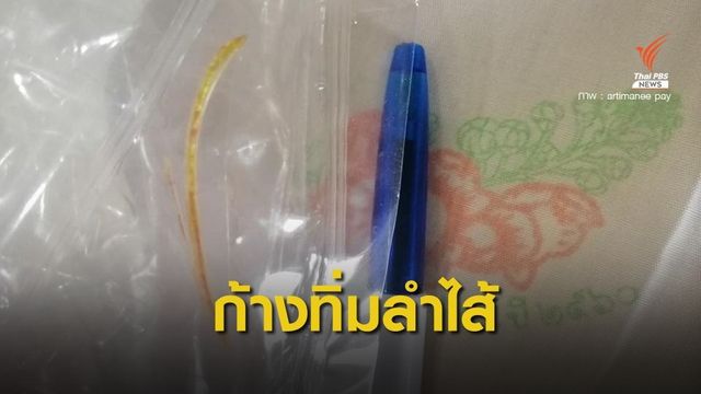 เพจดังเตือน! หญิงวัย 63 ปี กลืนก้างปลาทิ่มลำไส้เล็กอักเสบ
