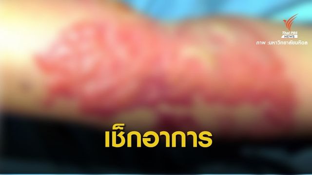 หมอเตือน "โรคไฟลามทุ่ง" จากเชื้อแบคทีเรียพบในสิ่งแวดล้อม