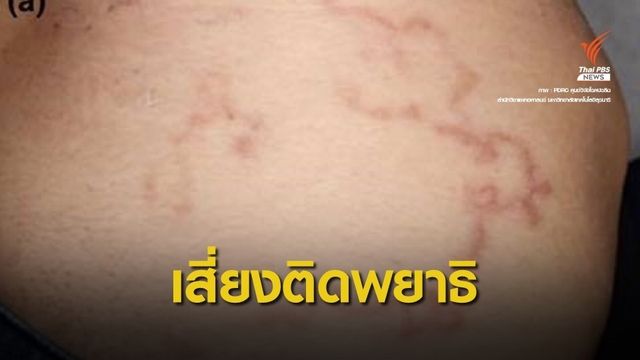 เตือน! กิน "ซาซิมิปลาเงิน" จำนวนมากเสี่ยงติดพยาธิตัวจี๊ด