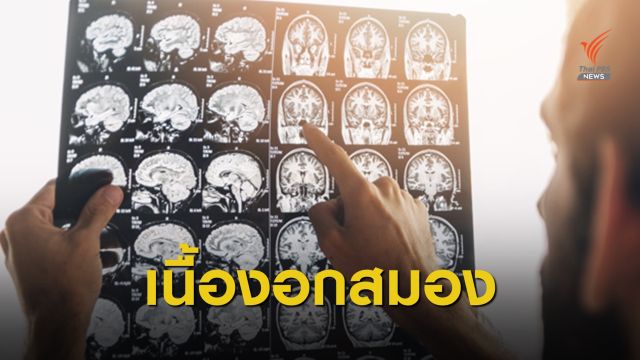 อย่าชะล่าใจ! เช็กสัญญาณ "เนื้องอกสมอง" ต้องรักษาทันที