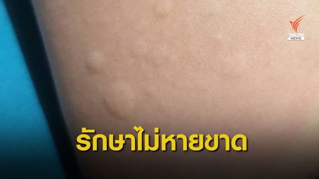 หมอชี้ "ภูมิแพ้ผิวหนัง" เป็นโรคเรื้อรังถ่ายทอดทางกรรมพันธุ์ 
