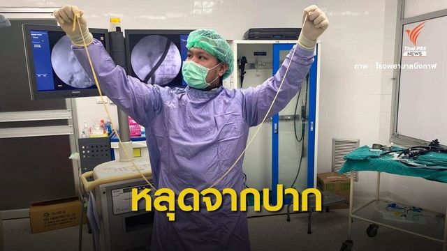  ตะลึง! "พยาธิตัวตืด” ยาว 2 เมตรหลุดจากปากผู้ป่วยท่อน้ำดี 