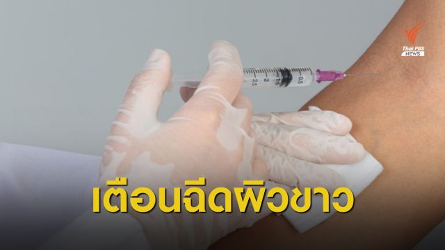 หมอเตือนฉีดวิตามินเข้าหลอดเลือด เสี่ยงแพ้รุนแรง-ติดเชื้อ