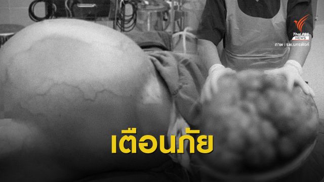 ผ่าตัดสำเร็จ! "มะเร็งรังไข่ยักษ์" หนัก 25 กิโลกรัม