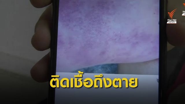 หมอเตือน "ตะขาบกัด" เสี่ยงติดเชื้อเข้ากระแสเลือดถึงตาย