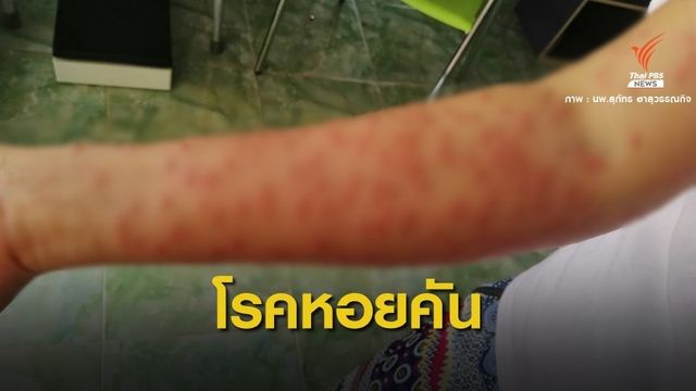 "หมอสุภัทร" เตือนโรคหอยคันระบาดพบคนป่วย 200 คน