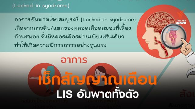 เตือน LIS อัมพาตทั้งตัว จากโรคหลอดเลือดสมองตีบ-แตก