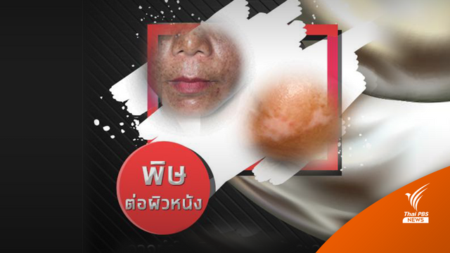 อย่าหาทำ! เอาสารปรอททาผิว หมอยันอันตรายต่อระบบประสาท-ผิว