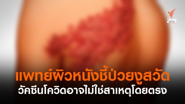 แพทย์ผิวหนังยังไม่สรุป ฉีดวัคซีนโควิดสาเหตุป่วย "งูสวัด" 