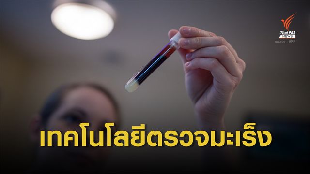 เทคโนโลยีตรวจหามะเร็งด้วยเลือดหยดเดียว ภายใน 2 ชั่วโมง