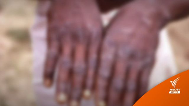 อนามัยโลกพบผู้ติดเชื้อ "ฝีดาษลิง" 80 คน ใน 12 ประเทศ