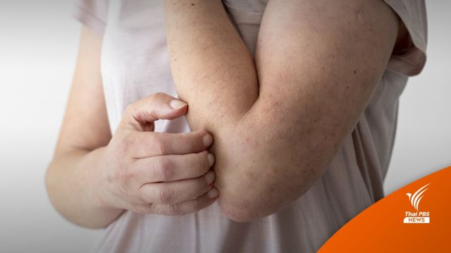 "แพ้อาหาร" อาการเป็นอย่างไร รุนแรงแค่ไหน หายได้หรือไม่?