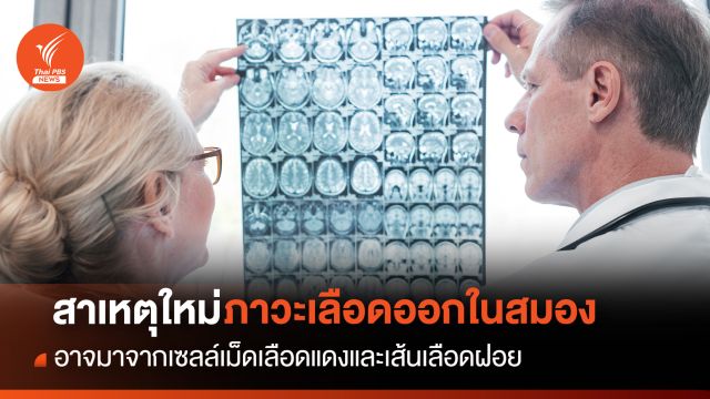 สาเหตุใหม่ "ภาวะเลือดออกในสมอง" อาจมาจากเซลล์เม็ดเลือดแดง และเส้นเลือดฝอย