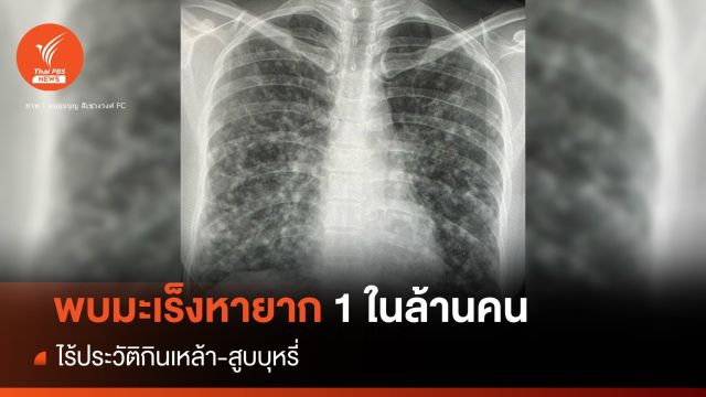 มะเร็งหายาก 1 ในล้านคน ไร้ประวัติกินเหล้า-สูบบุหรี่