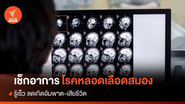 เช็กอาการ "โรคหลอดเลือดสมอง" รู้เร็วลดเกิดอัมพาต-เสียชีวิต