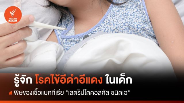 รู้จัก! ไข้อีดำอีแดง พิษของเชื้อแบคทีเรีย "เสตร็ปโตคอสคัส ชนิดเอ" 