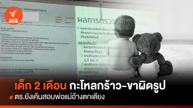 เร่งคลี่ปมเด็ก 2 เดือนเจ็บหนักกะโหลกร้าว-ขาผิดรูป