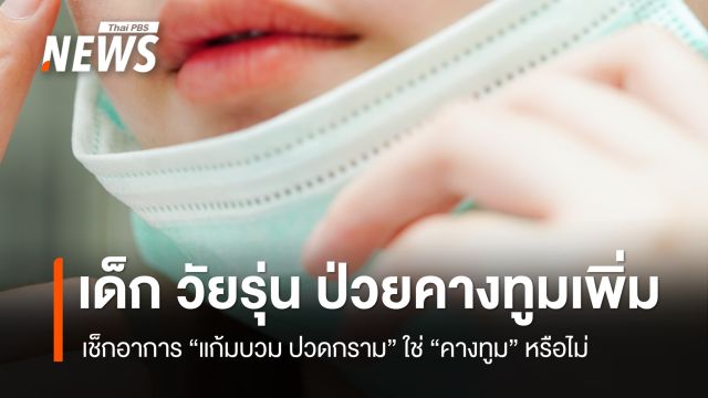 แพทย์เตือน เด็ก วัยรุ่น ป่วยคางทูมเพิ่ม เช็กอาการ "แก้มบวม ปวดกราม" ใช่ "คางทูม" หรือไม่ 