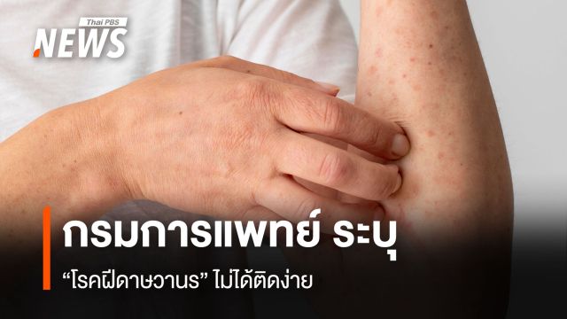 "กรมการแพทย์" ระบุประชาชนไม่ต้องตื่นตระหนก "โรคฝีดาษวานร" ไม่ได้ติดง่าย