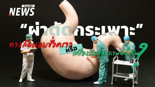 "ผ่าตัดกระเพาะ" ทางลัดผอมชั่วคราว หรือ เครื่องมือสู่สุขภาพดียั่งยืน ?