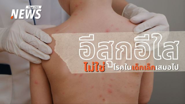 "อีสุกอีใส" ไม่ใช่โรคในเด็กเล็กเสมอไป รู้จักอาการ การติดต่อ กลุ่มเสี่ยงที่ต้องระวัง