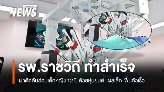 รพ.ราชวิถี ประสบความสำเร็จ ผ่าตัดตับอ่อนเด็กหญิง 12 ปี ด้วยหุ่นยนต์ แผลเล็ก-ฟื้นตัวเร็ว