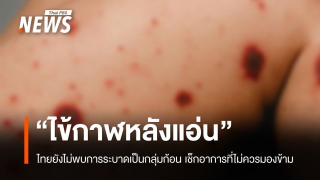 อัปเดตสถานการณ์ "ไข้กาฬหลังแอ่น" เช็กอาการที่ไม่ควรมองข้าม