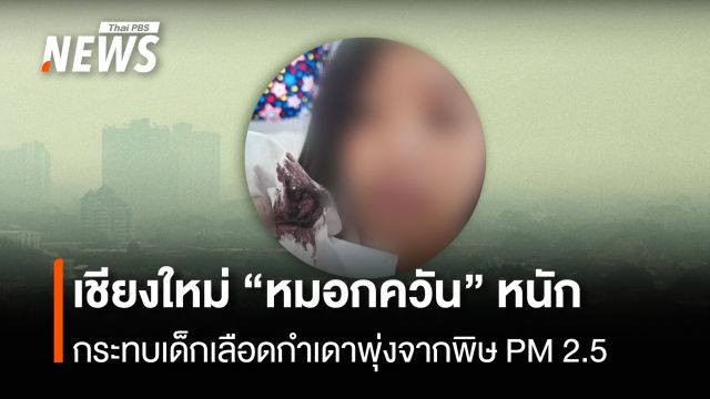 เชียงใหม่ "หมอกควัน" หนัก กระทบเด็กเลือดกำเดาพุ่งจากพิษ PM 2.5